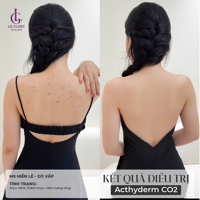 Peel da trị mụn lưng