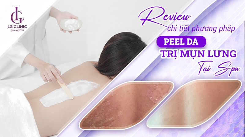 peel da trị mụn lưng