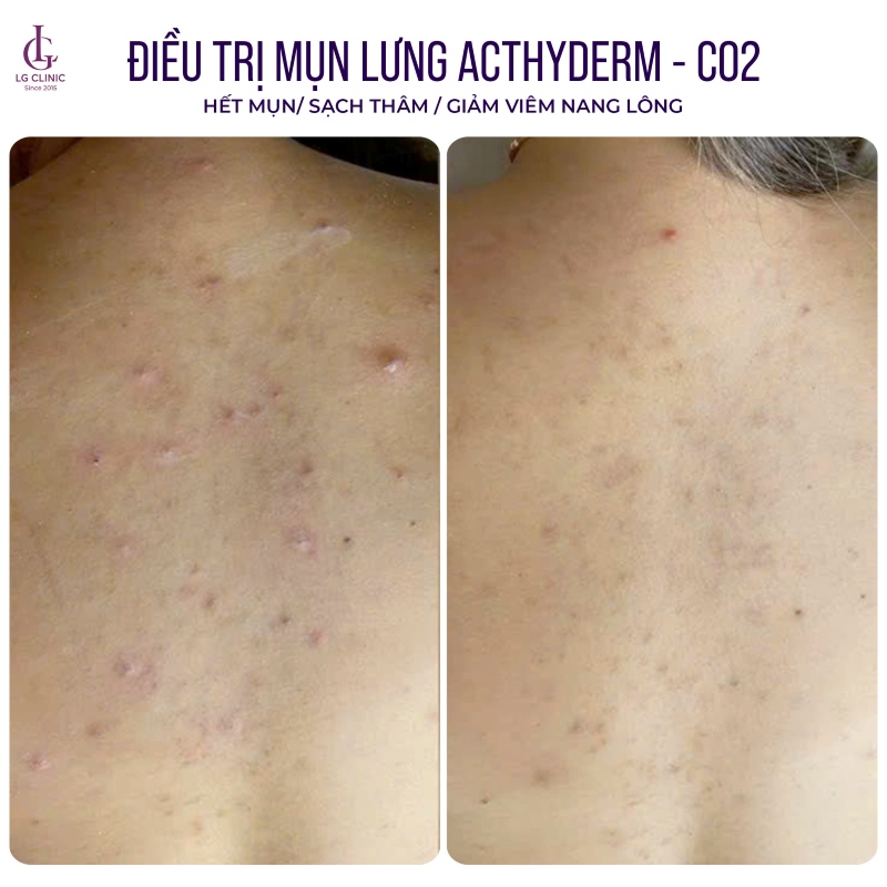 Phòng khám Da liễu trị mụn lưng LG Clinic