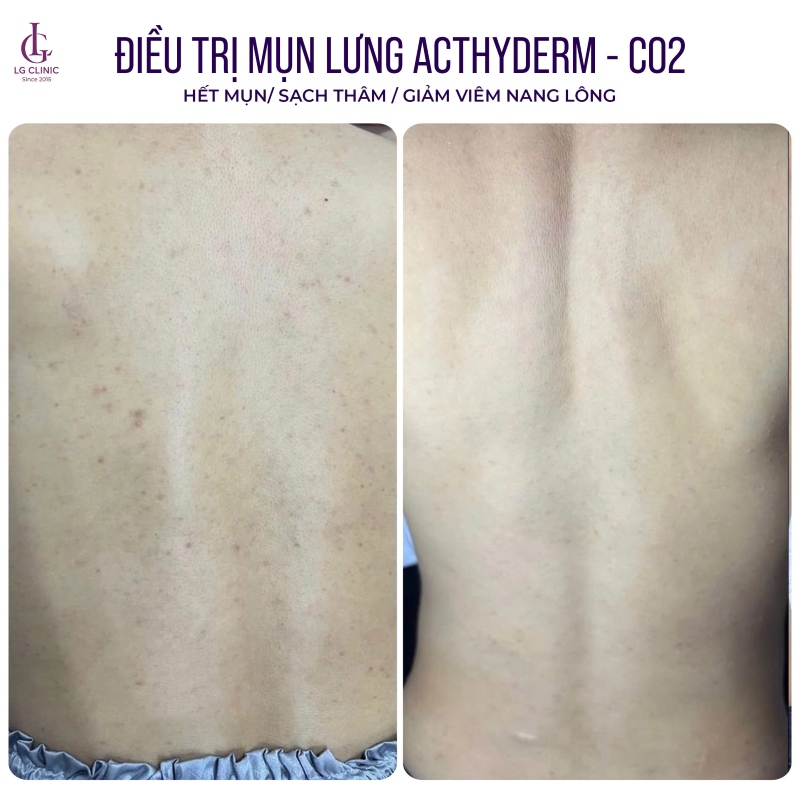 Phòng khám Da liễu trị mụn lưng LG Clinic
