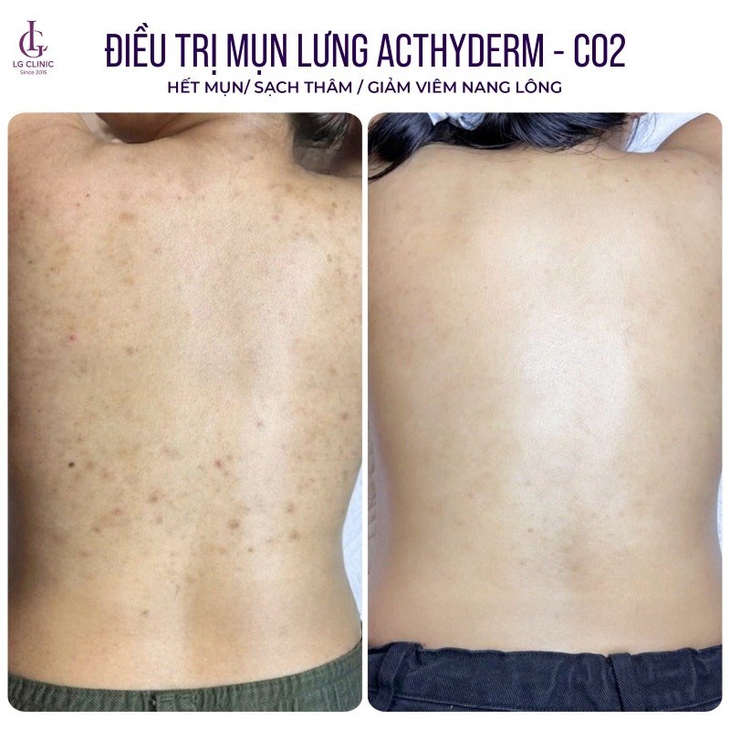 Phòng khám Da liễu trị mụn lưng LG Clinic
