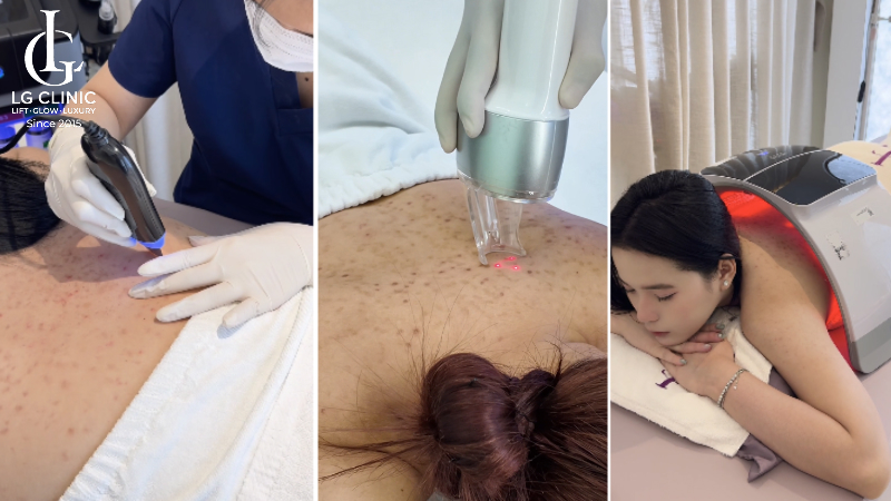 spa trị mụn lưng