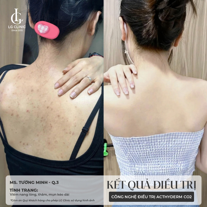 spa trị mụn lưng