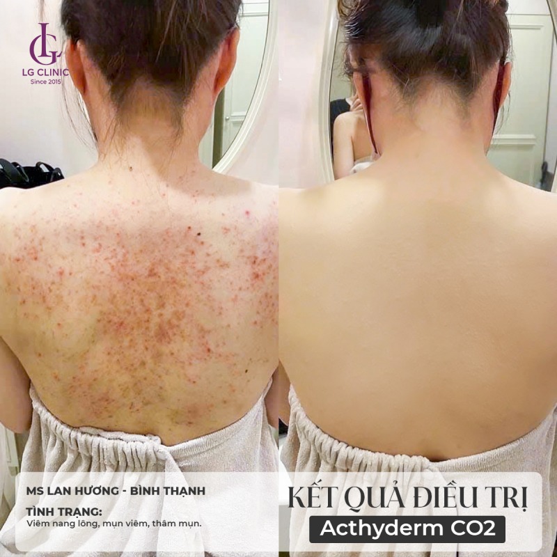 spa trị mụn lưng