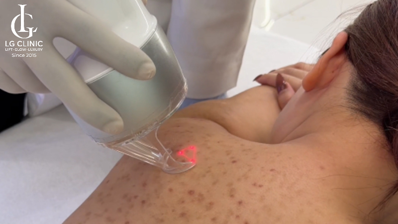 spa trị mụn lưng