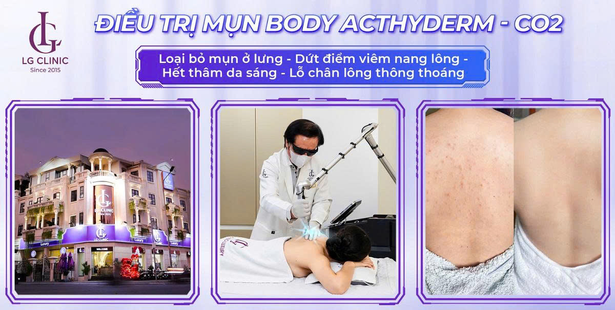 spa trị mụn lưng uy tín an toàn