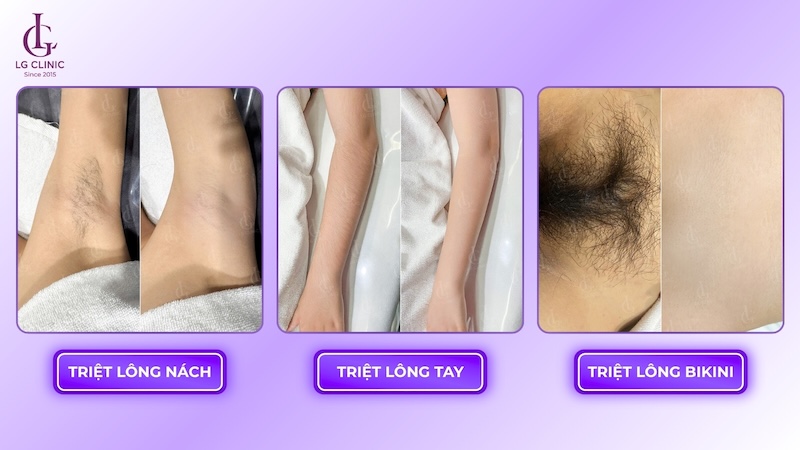 kết quả triệt lông