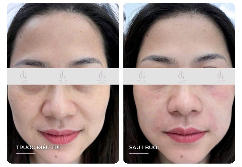 Hình ảnh thực tế của khách hàng trước và sau tiêm Jalupro
