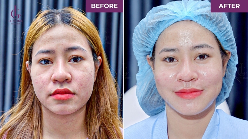 Khách hàng trước và sai khi tiêm Profhilo tại LG Clinic