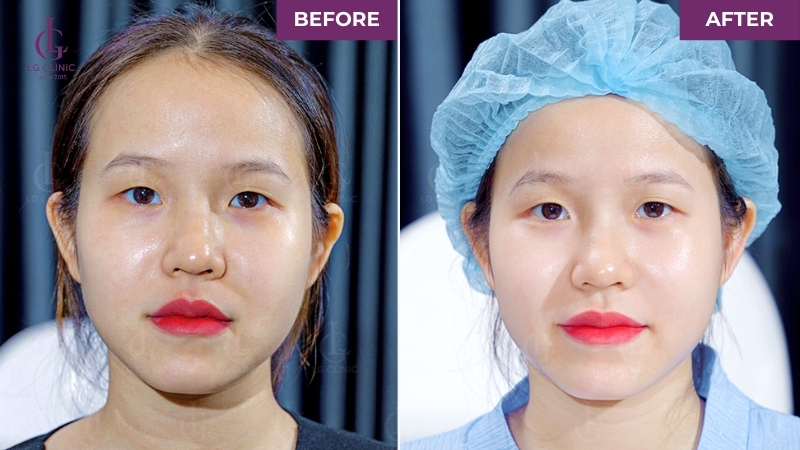 Khách hàng trước và sai khi tiêm Profhilo tại LG Clinic