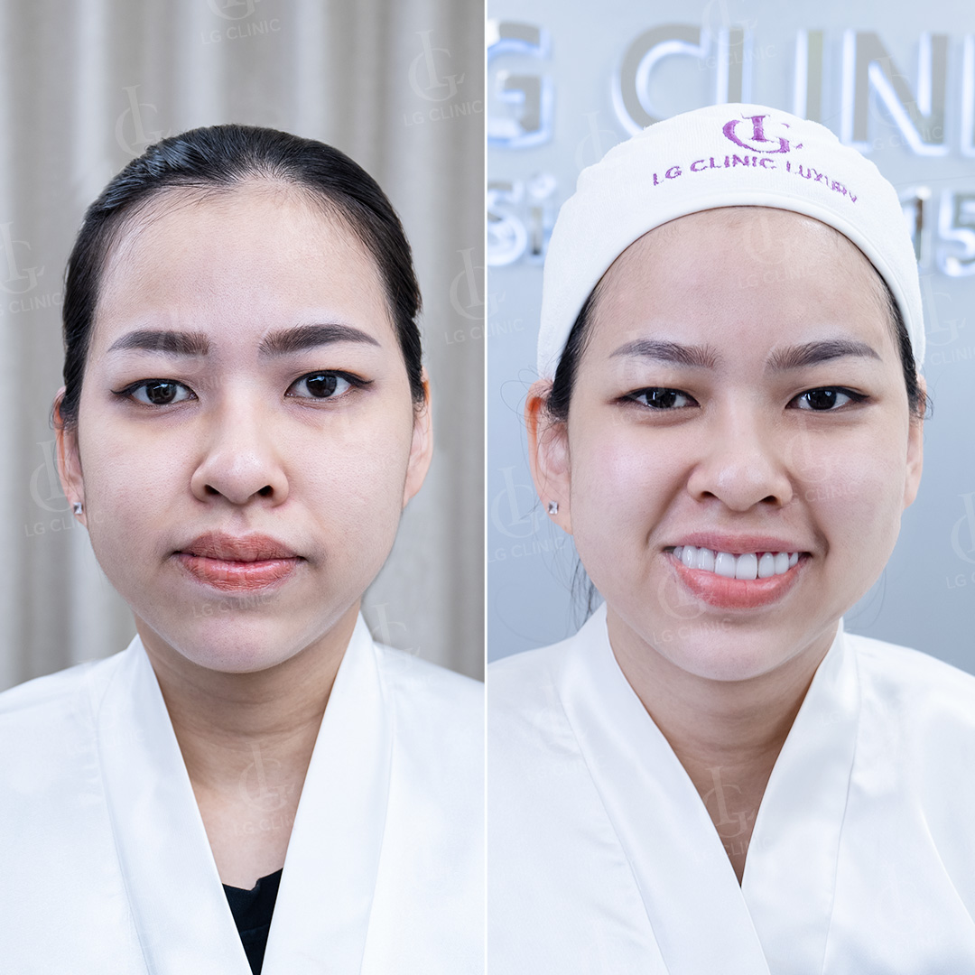 Chị Thuý Quỳnh - Bình Thạnh sau liệu trình tiêm Rejuran trẻ hoá da