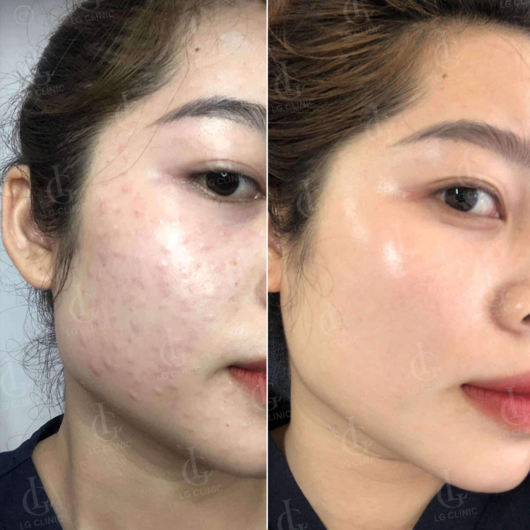Chị Nga - địa chỉ ở Quận 8 trước và sau khi tiêm Rejuran