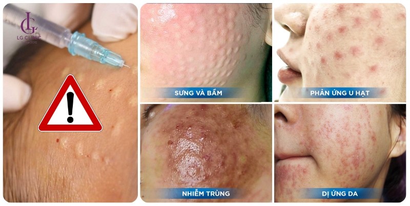 Biến chứng tiêm Rejuran