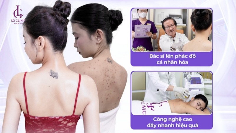 cách trị mụn lưng