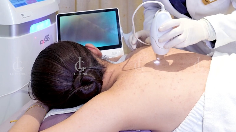 cách trị mụn lưng