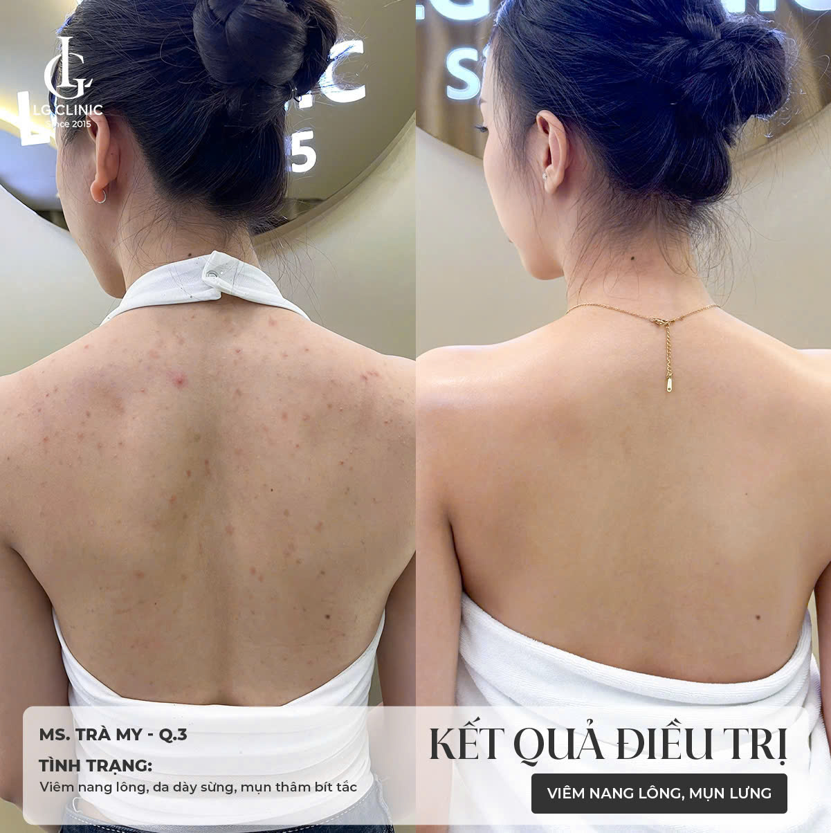 cách trị mụn lưng