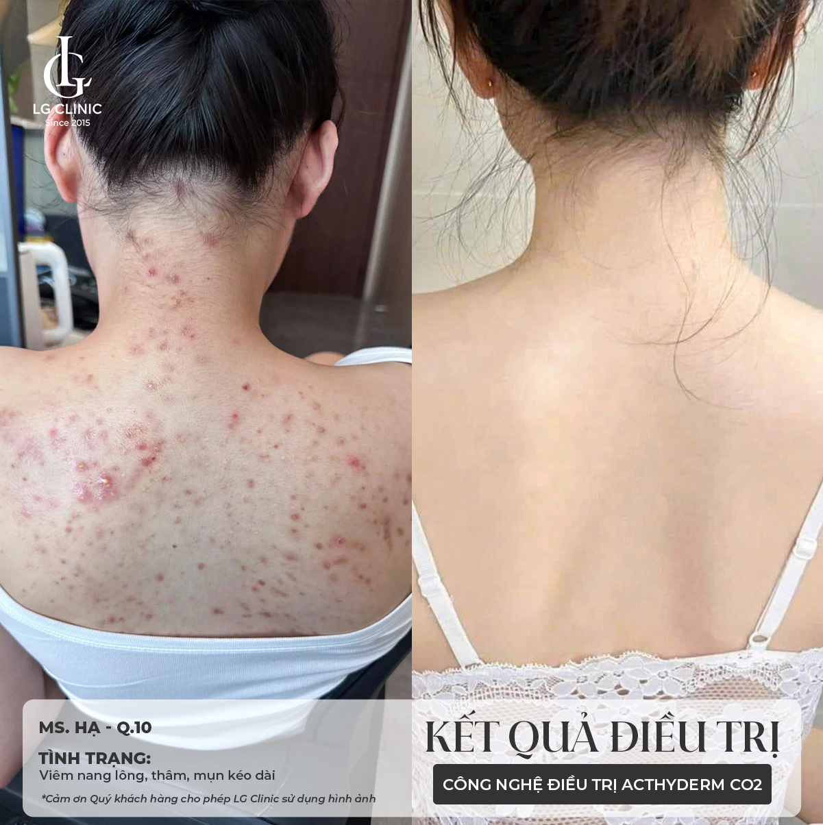 cách trị mụn lưng