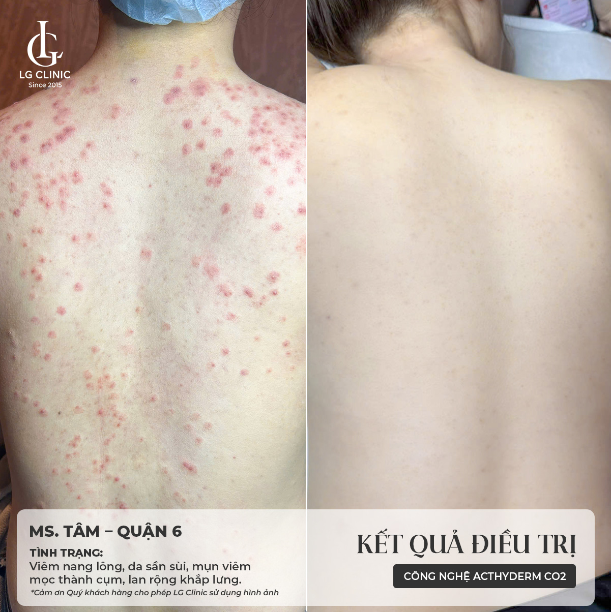 cách trị mụn lưng