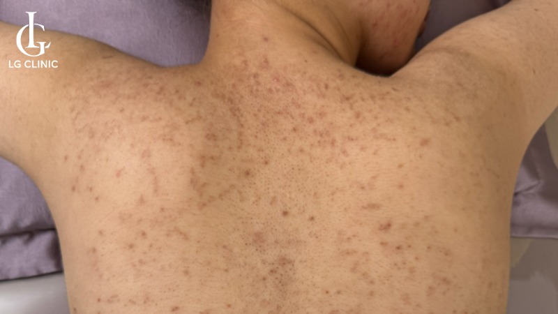 cách trị mụn lưng