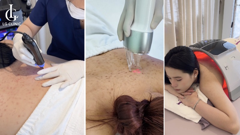 cách trị mụn lưng