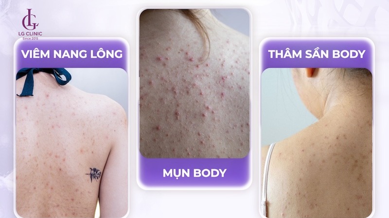 cách trị mụn lưng