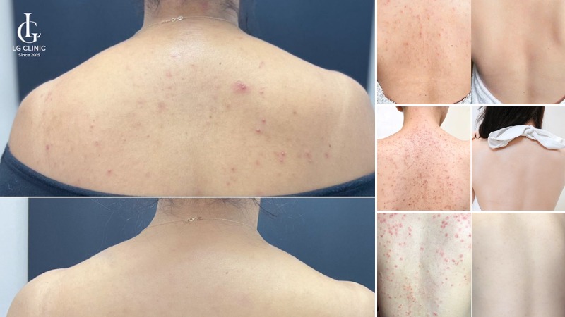 cách trị mụn lưng