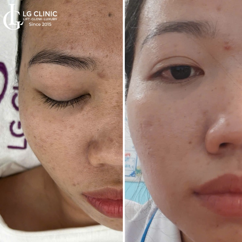 trị thâm mụn bằng tỏi