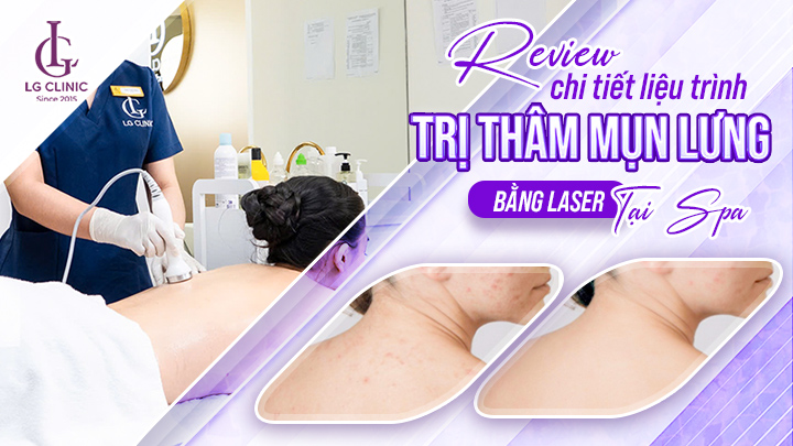 Trị thâm mụn lưng bằng laser