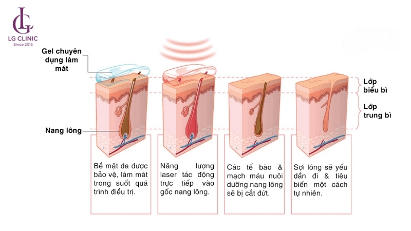 triệt lông bằng laser