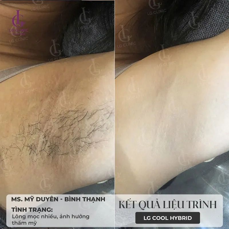triệt lông nách