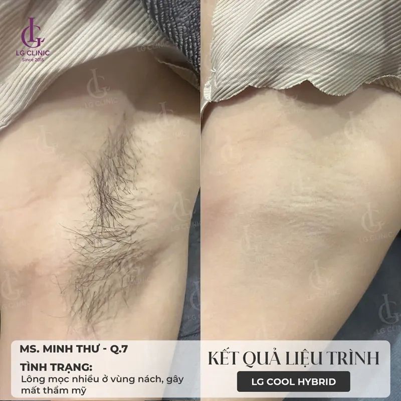 triệt lông nách