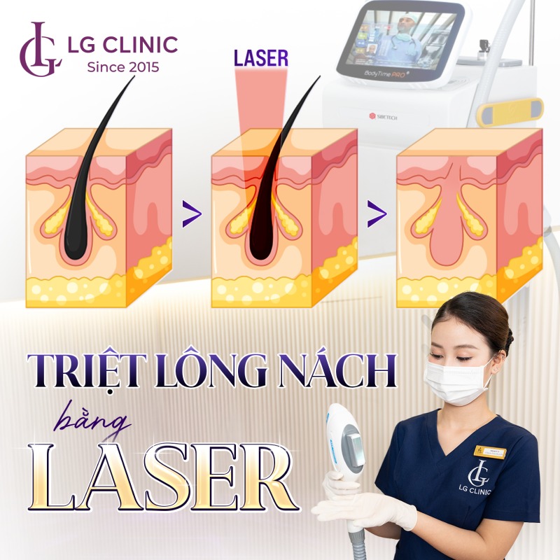 dịch vụ triệt lông nách vĩnh viễn