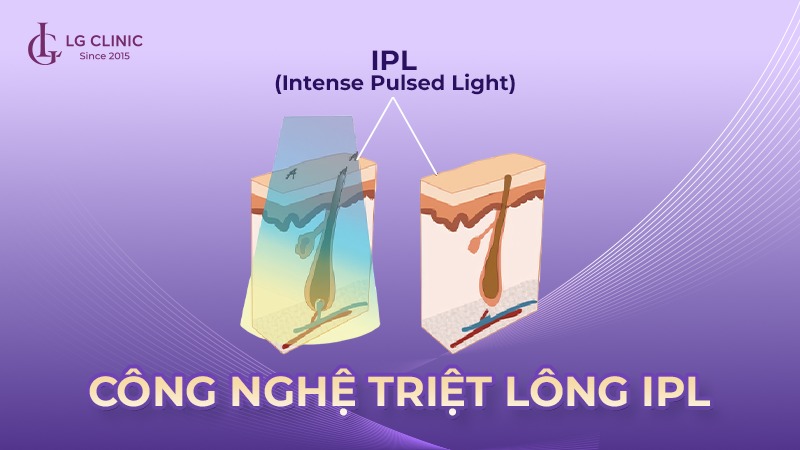 triệt lông nách