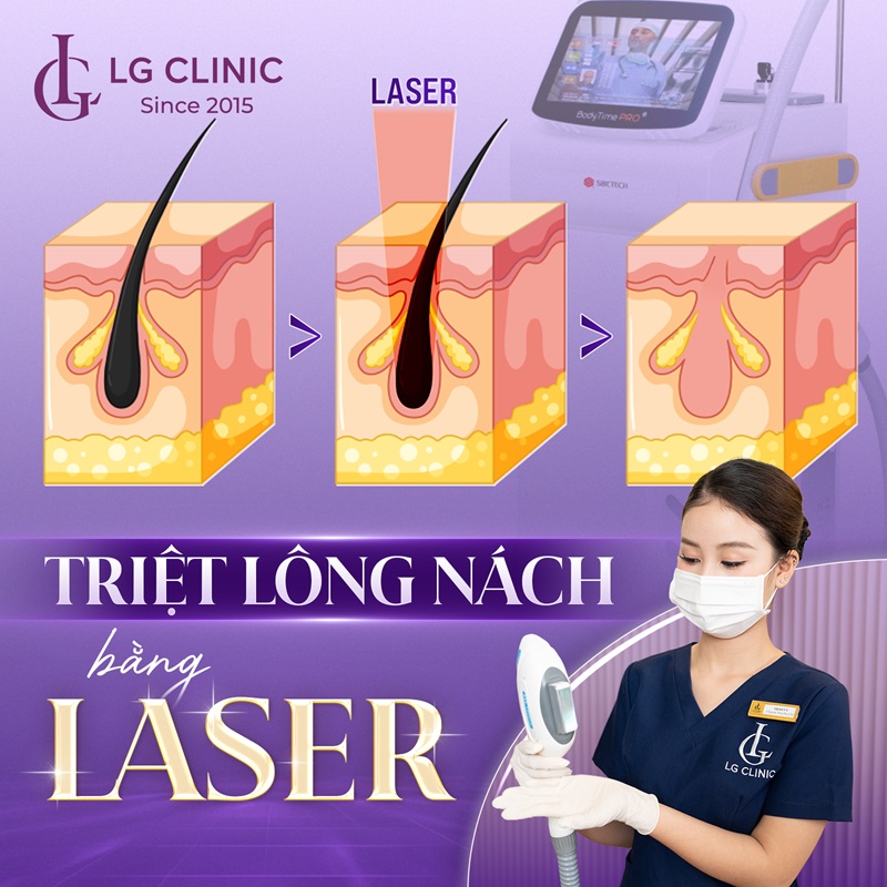 triệt lông nách