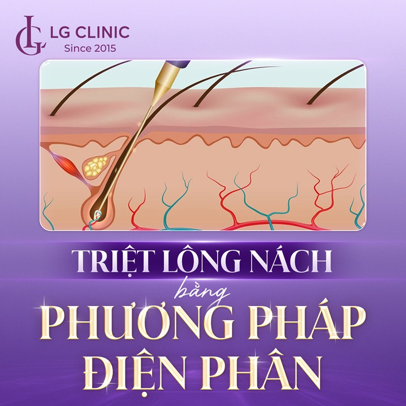 triệt lông nách
