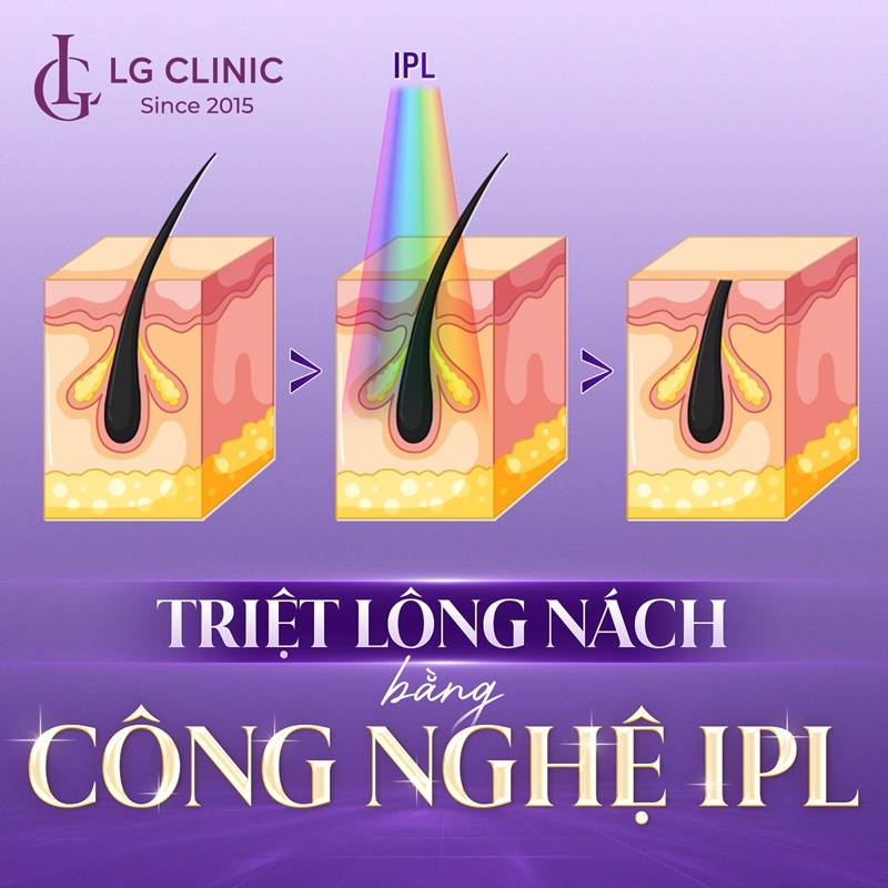 triệt lông nách