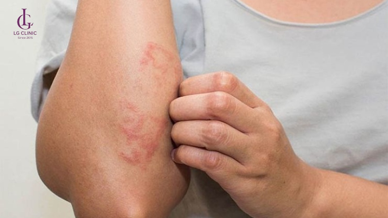 Trường hợp không nên áp dụng mẹo triệt lông dân gian cho da nhạy cảm hoặc đang tổn thương.