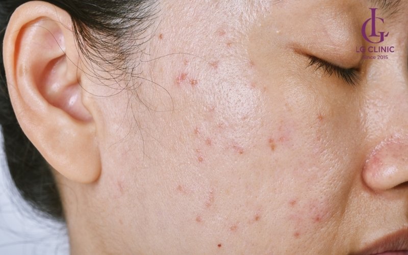 Da mặt bị kích ứng sau khi cấy trắng collagen