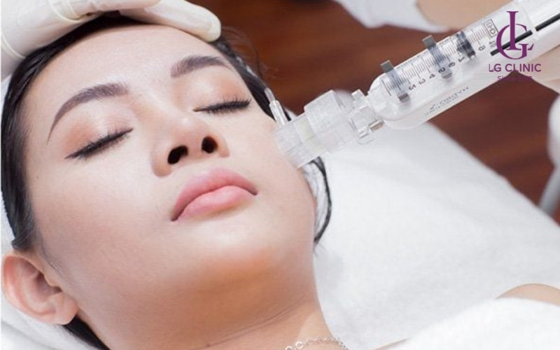 Cấy trắng collagen vào lớp hạ bì của da mặt