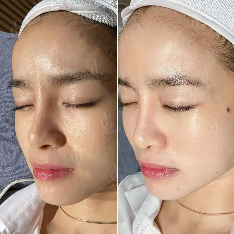 cấy trắng collagen