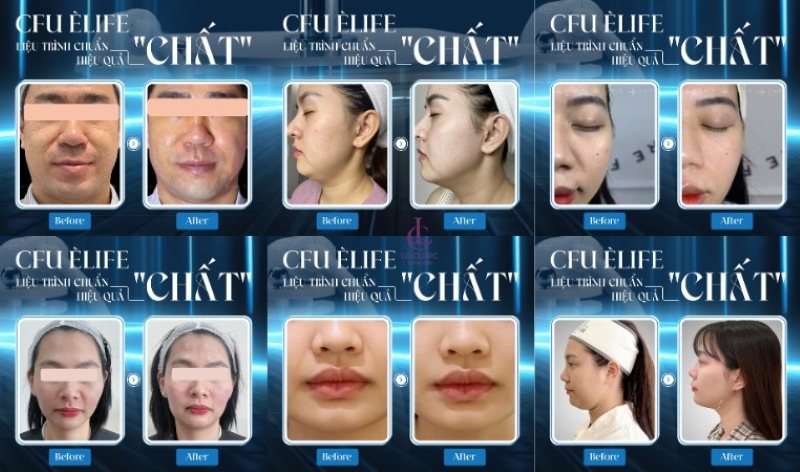 Công nghệ CFU Èlife