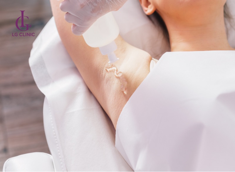 Quy trình triệt lông nách tại Spa