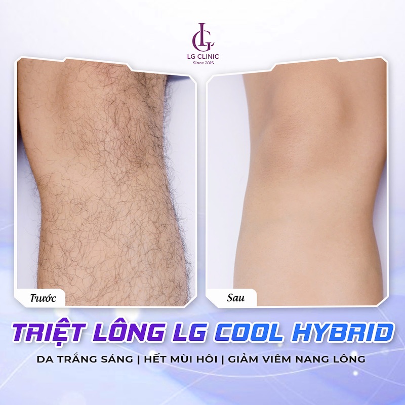 hình ảnh triệt lông của khách hàng nam tại lg clinic