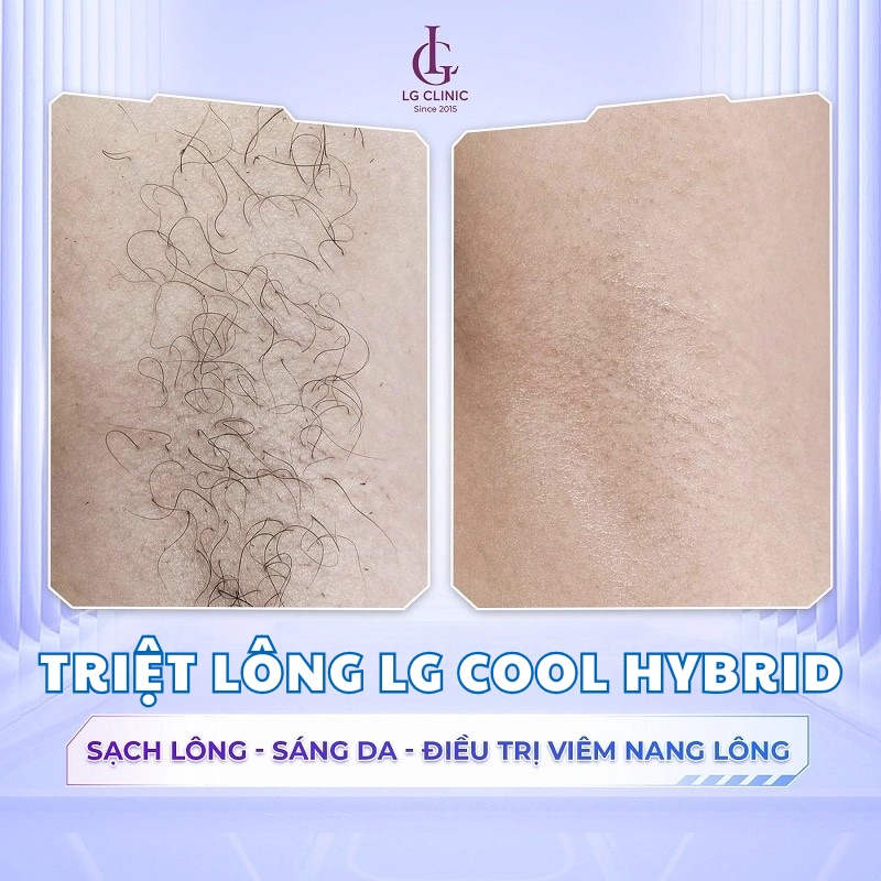 hình ảnh triệt long tại lg clinic
