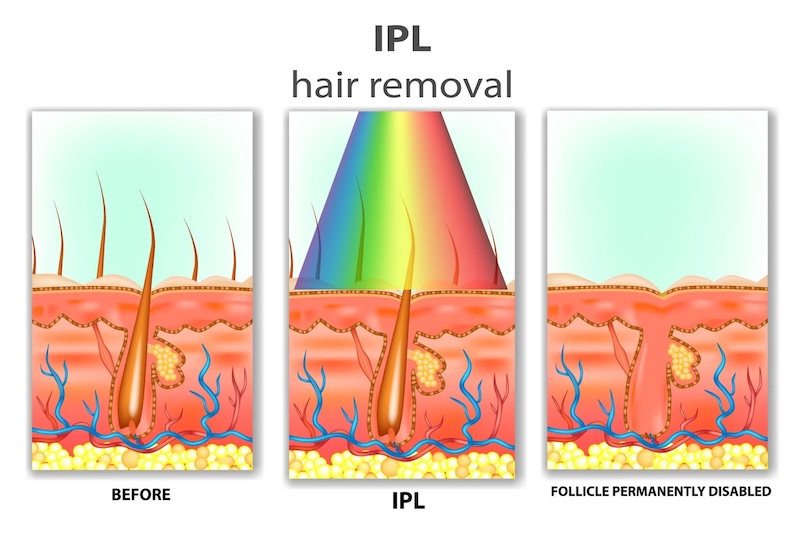 Triệt lông IPL hiệu quả với công nghệ ánh sáng xung an toàn cho da