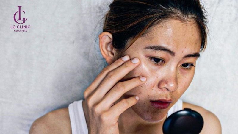Làn da xỉn màu sau khi sinh