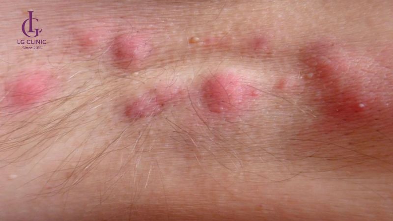 tẩy lông bằng kem đánh răng có thể gây kích ứng
