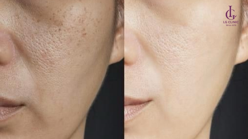 Thâm sạm và lỗ chân lông to do triệt lông mặt sai cách.