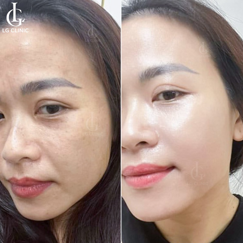 hấp trắng da mặt