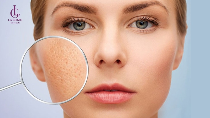 Triệt lông mặt giúp giảm dầu, se khít lỗ chân lông và hạn chế mụn hiệu quả.